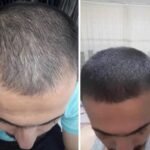 NUH SAÇ FIŞKIRTAN SAÇ BAKIM SETİ