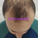 2 sarı saç solüsyonu 1 kalınlaştıran kür
