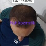 2 sarı saç solüsyonu 1 kalınlaştıran kür