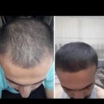 2 sarı saç solüsyonu 1 kalınlaştıran kür